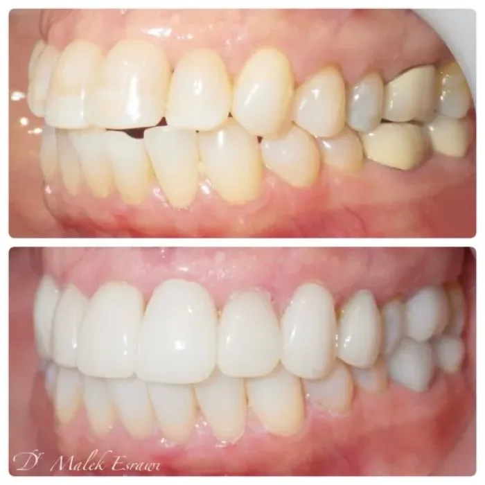 Before and after dental smile transformation, angle 1, real patient of Dr. Esrawi