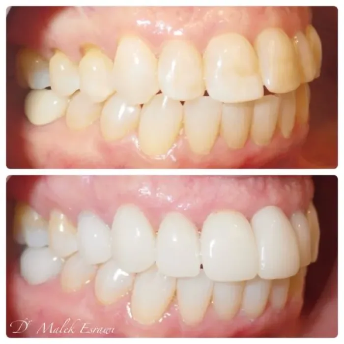Before and after dental smile transformation, angle 2, real patient of Dr. Esrawi