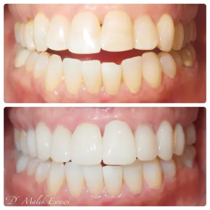 Before and after dental smile transformation, angle 3, real patient of Dr. Esrawi