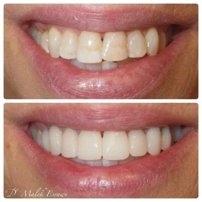 Before and after dental smile transformation, angle 4, real patient of Dr. Esrawi